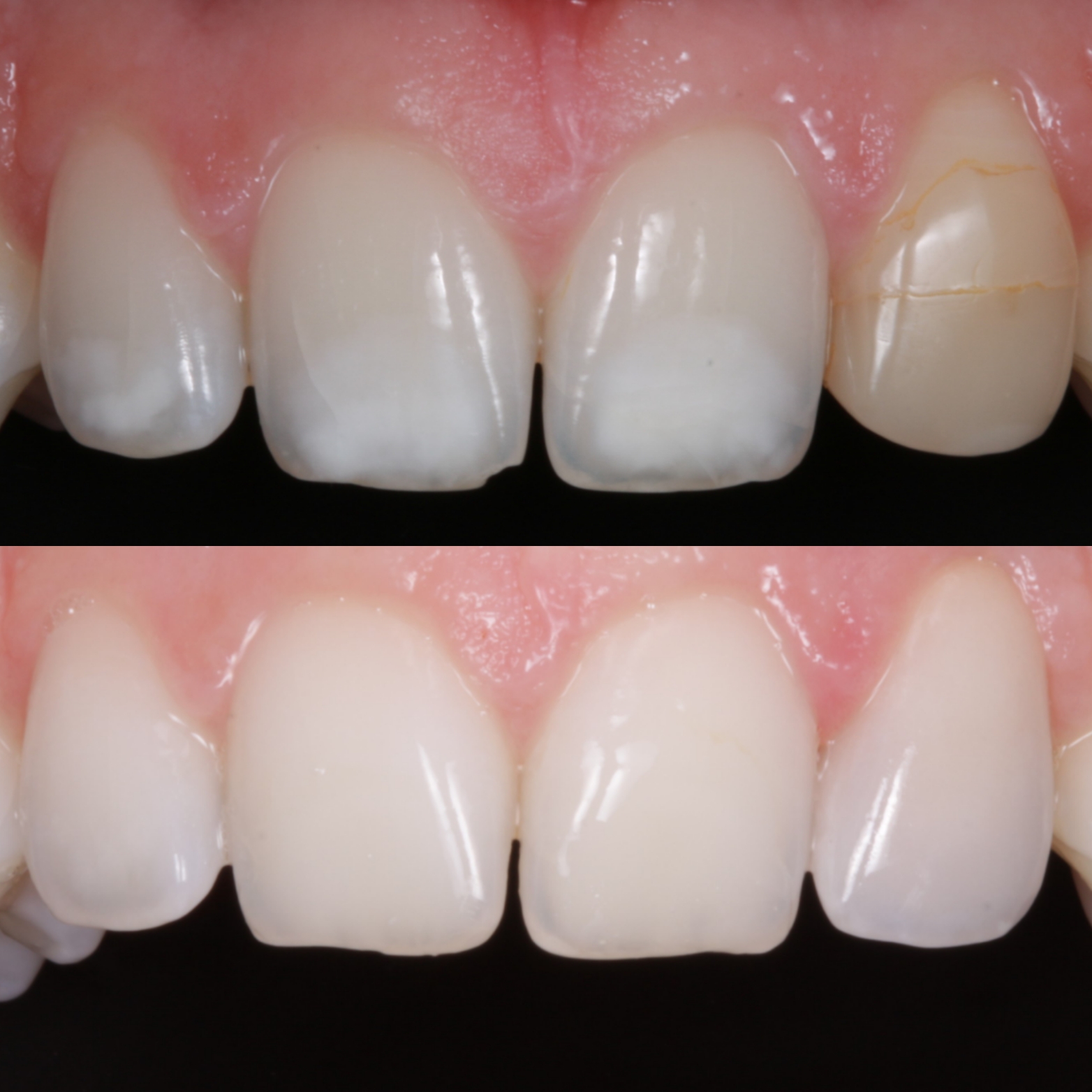 Tooth Discolouration Reading - Icon Teeth Treatment - White Spots
